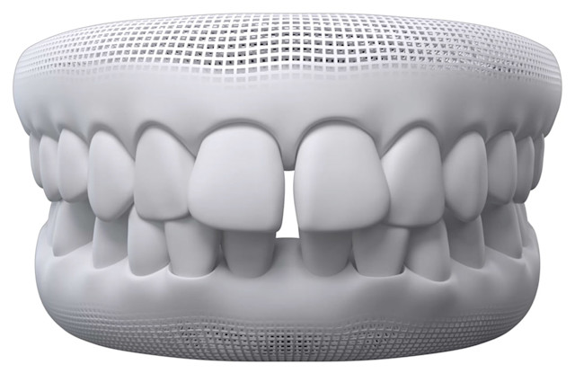 Gap teeth explained: causes & treatment | Invisalign