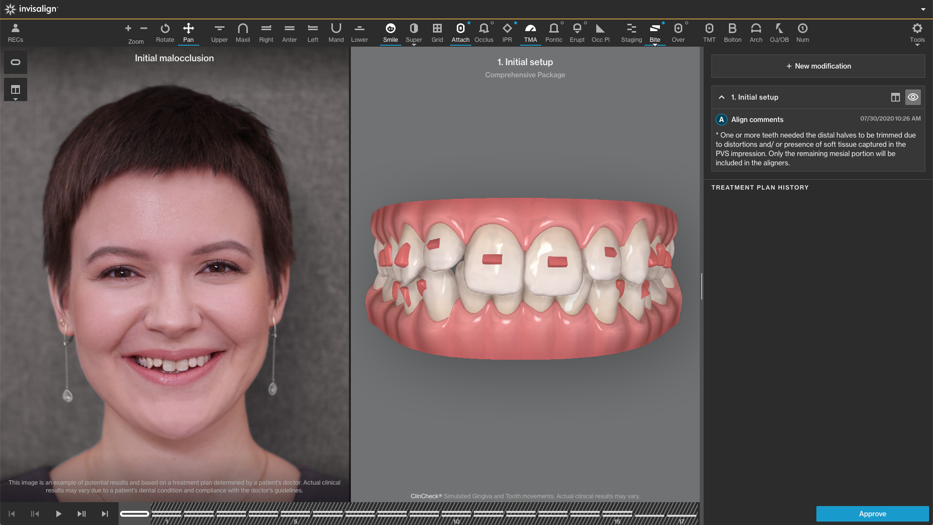 ClinCheck Pro Software treatment view
