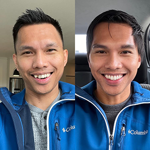 Young man testimonial before and after treatment with transparent aligners