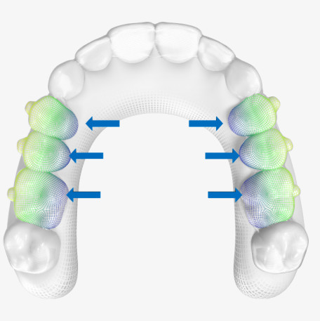 Invisalign G8 sample of predictable posterior arch expansion