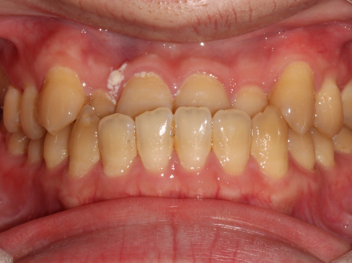 Anterior crossbite tooth case before Invisalign® treatment