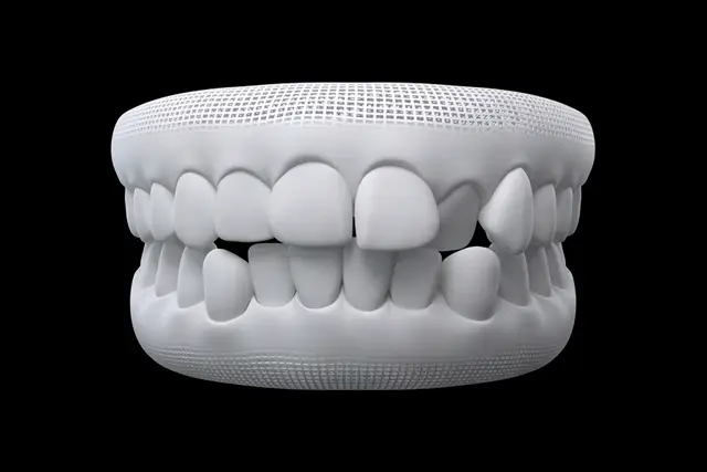 How Invisalign Works Invisalign treatment moves teeth using clear aligners