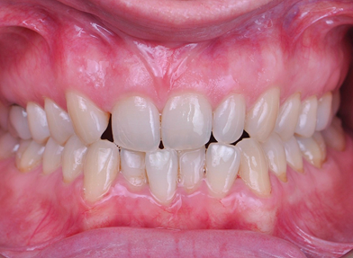 The patient presented with Class I malocclusion, crowding, edge to edge bite, missing 1.2 and narrow arches. The main goal of treatment was the treatment was opening 1.2’s implant space.