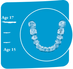 image-card-age-17-vivera-retainers