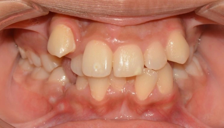Crowding tooth case before Invisalign® treatment
