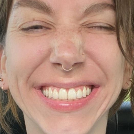Young woman after Invisalign® treatment