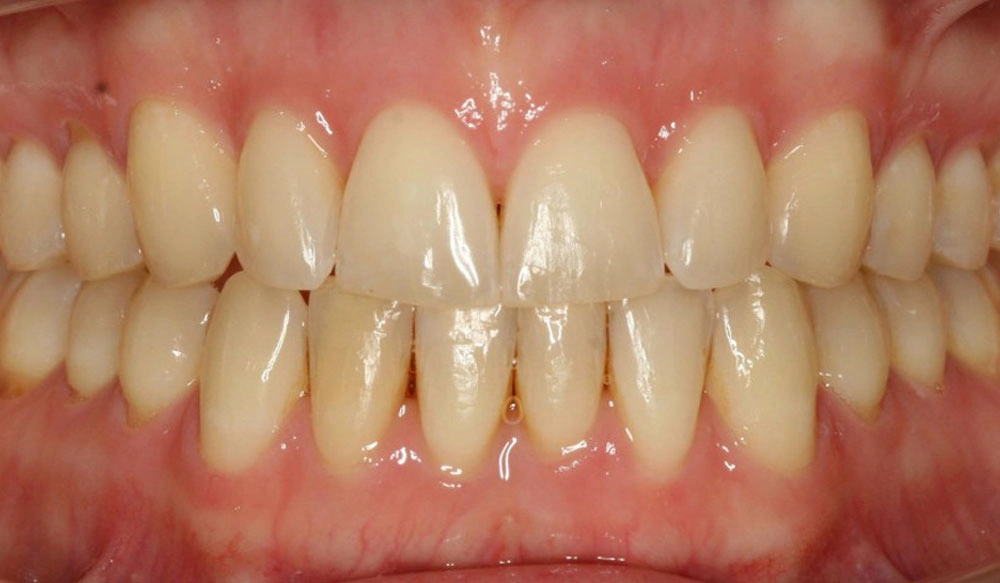 Open bite tooth case after Invisalign® treatment