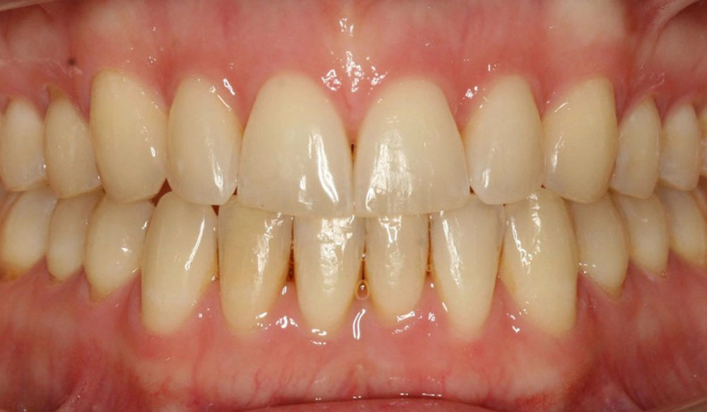 Open bite tooth case after Invisalign® treatment