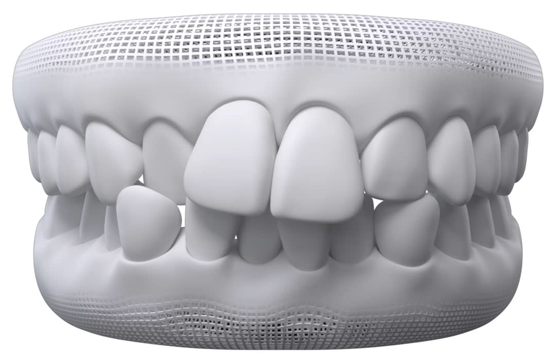 Crowded teeth