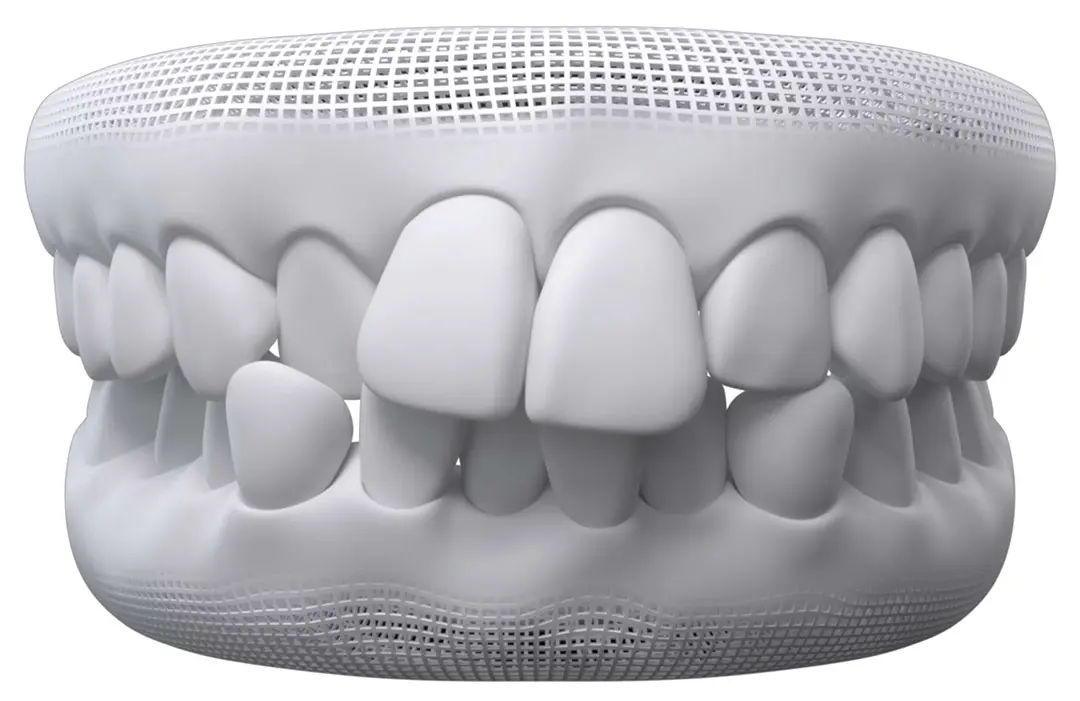 Invisalign Treatment for Teeth Crowding |Invisalign® clear aligners