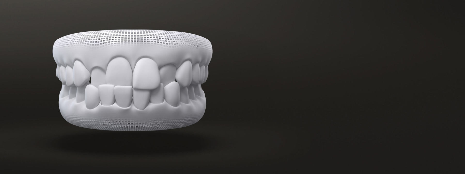 Morso incrociato: modello 3D prima del trattamento con allineatori dentali Invisalign