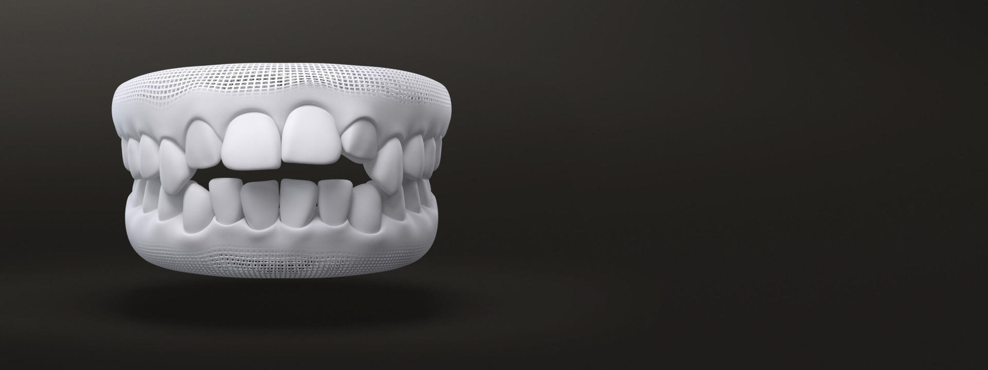 Morso aperto modello 3D: casi trattabili con allineatori dentali Invisalign Italia