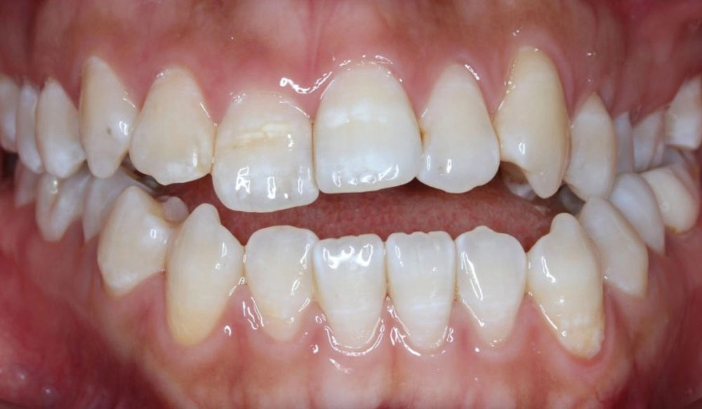 Posterior crossbite tooth case before Invisalign® treatment