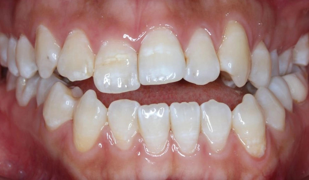 Posterior crossbite tooth case before Invisalign® treatment