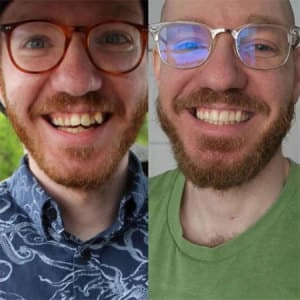 Young man testimonial before and after treatment with transparent aligners