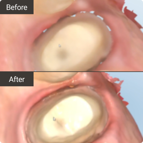 image-text-and-media-itero-lumina-scanner-updates