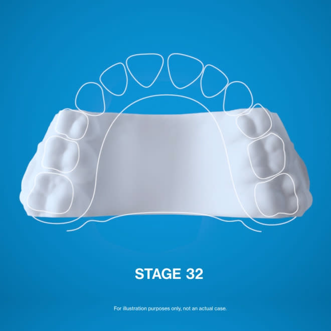 Cyfrowy model 3D ekspandera podniebiennego Invisalign® na niebieskim tle