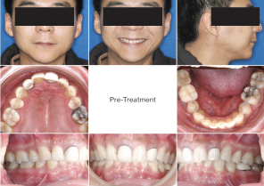 case report Boy teeth
