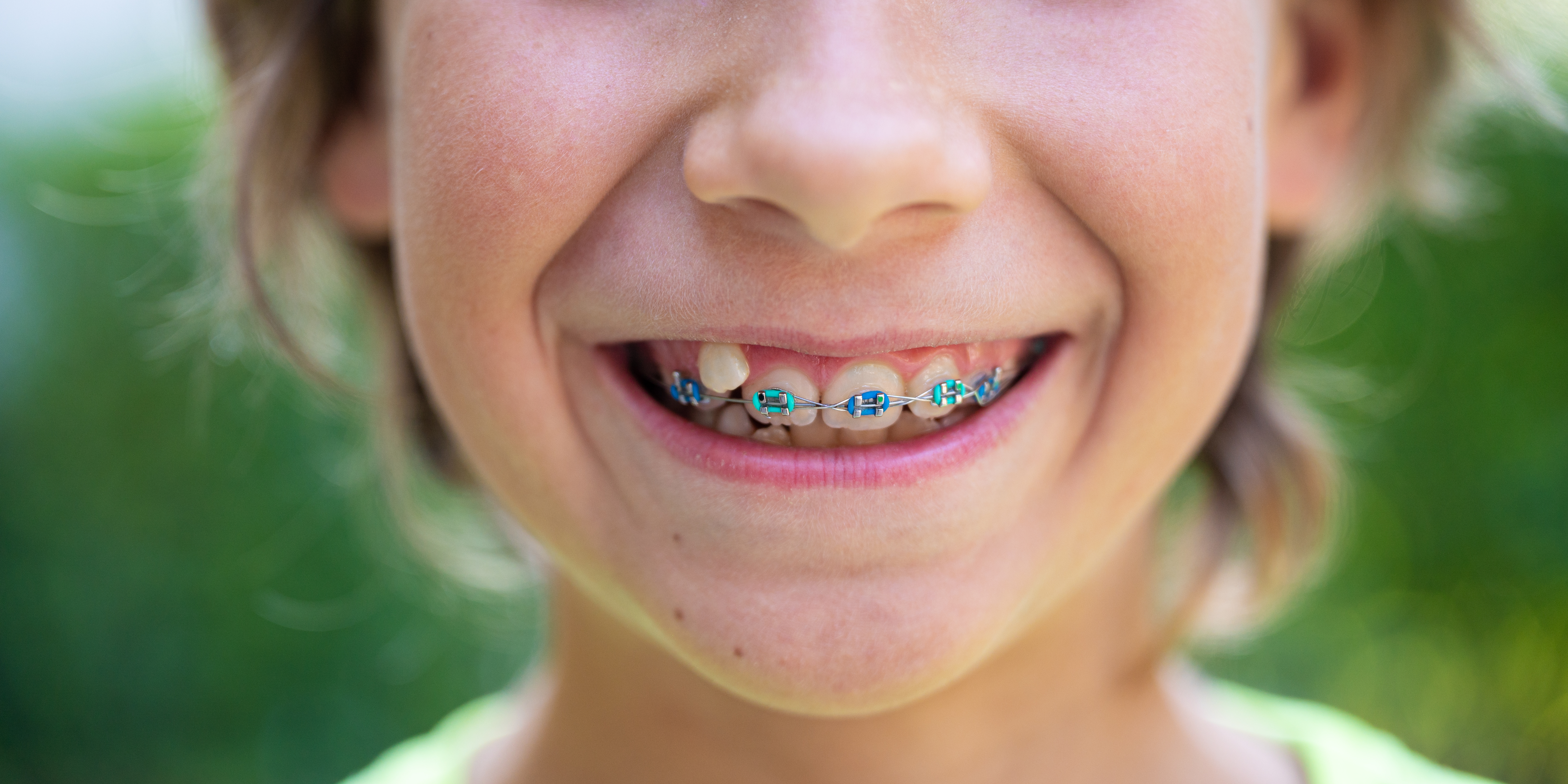 What are the different types of braces for kids? 