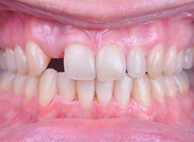 Prosthodontic Dentistry Post pre-restorative case second