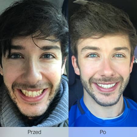 Before and after: discover Invisalign treatments
