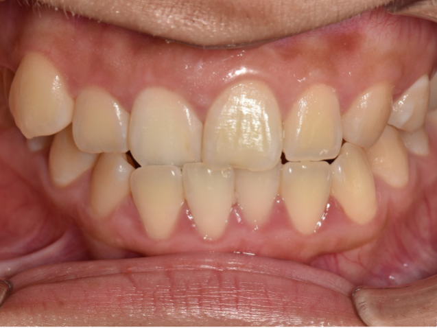 before image