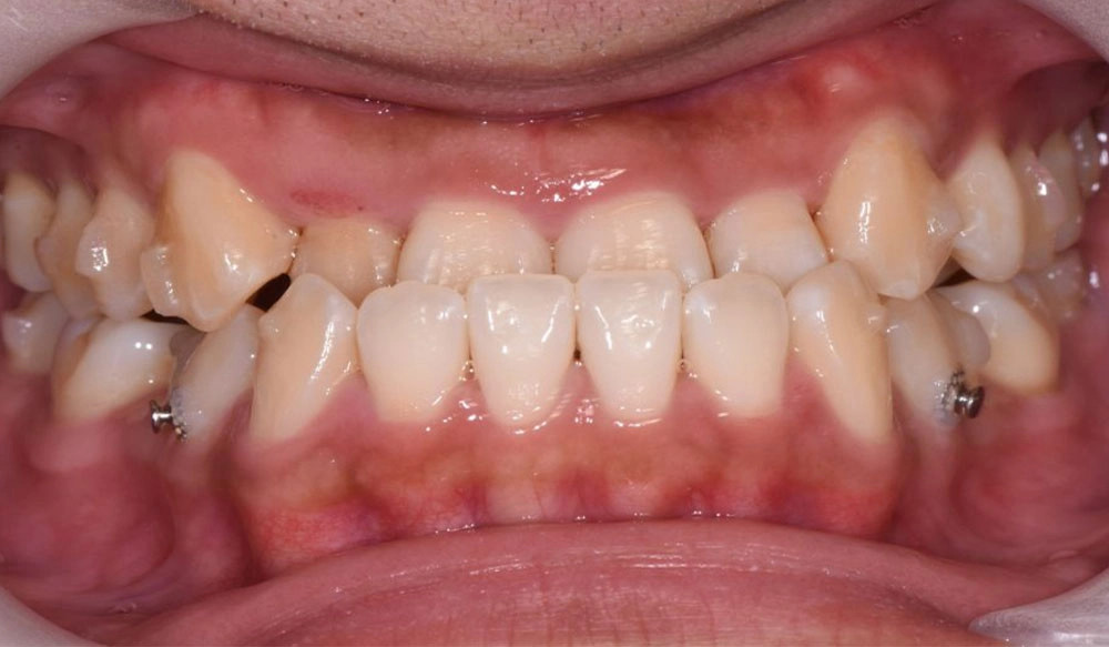 Class III tooth case before Invisalign® treatment