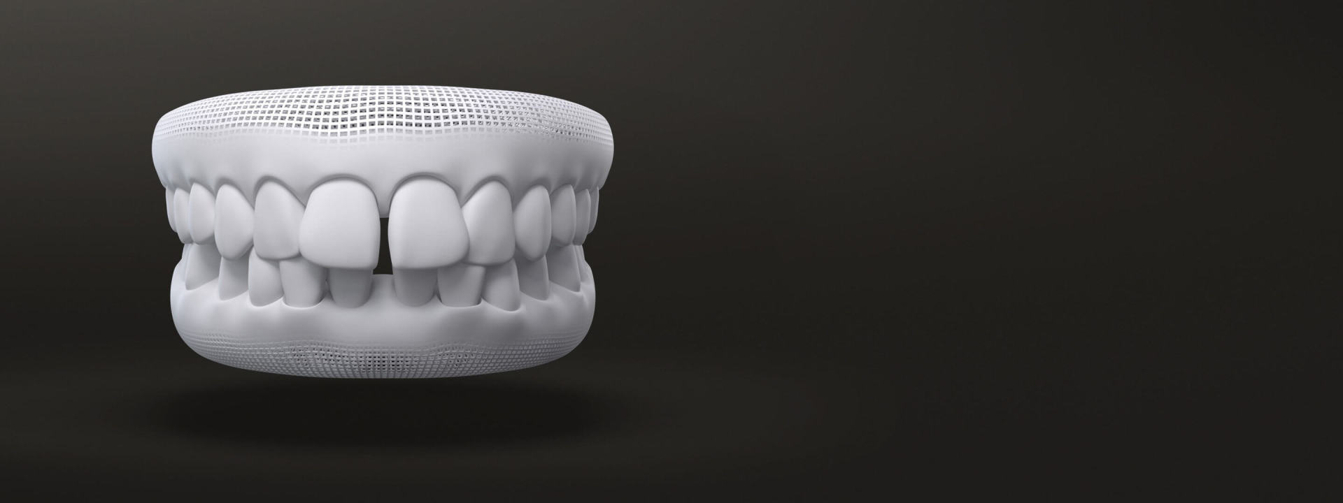 Spazi tra i denti modello 3D: prima degli allineatori dentali Invisalign - Italia
