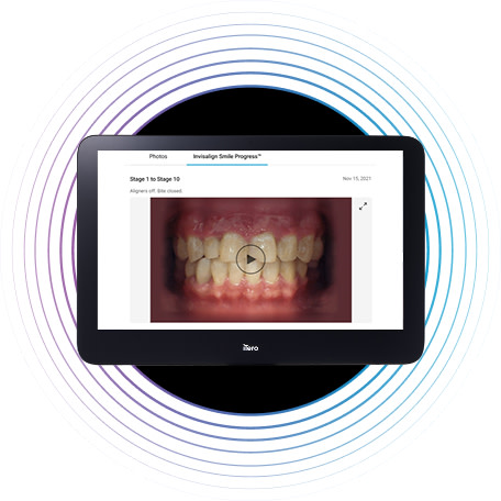 Innovation | Monitor | Invisalign Smile Progress™ Video