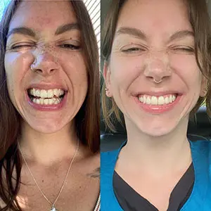 Young woman testimonial before and after treatment with transparent aligners