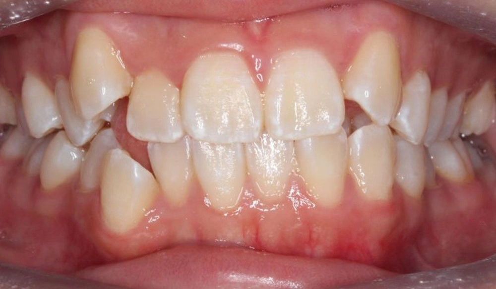 Extraction tooth case before Invisalign® treatment