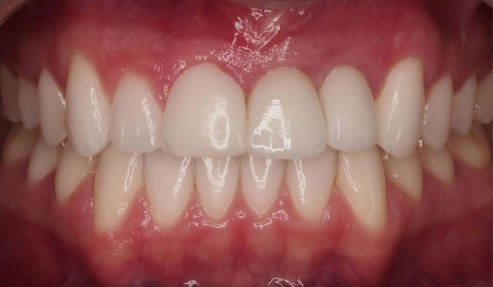 Surgical treatment tooth case after Invisalign® treatment