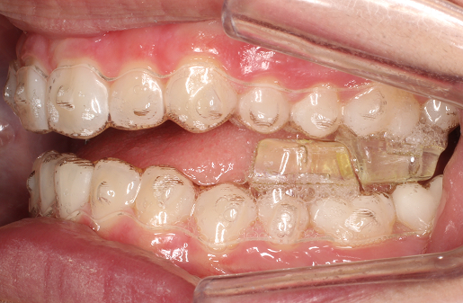Mandibular Advancement Occlusal Blocks