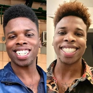 Young man testimonial before and after treatment with transparent aligners