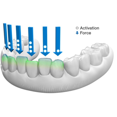 Invisalign G8 sample of predictable deep bite correction