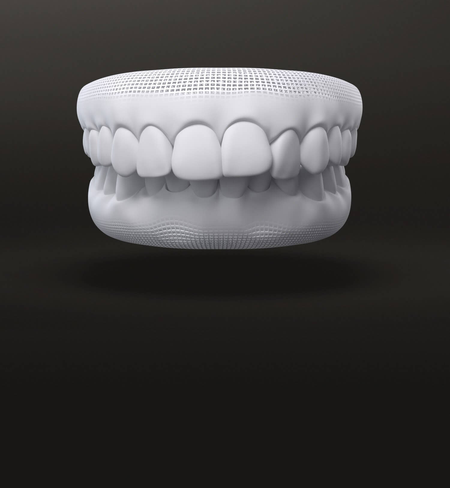 Over bite 3D model - Invisalign treatments - UK