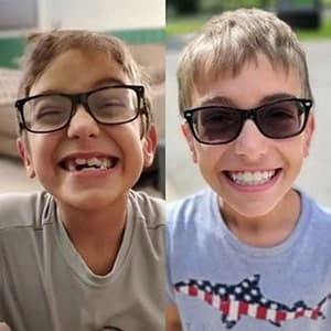 Little boy testimonial before and after treatment with transparent aligners