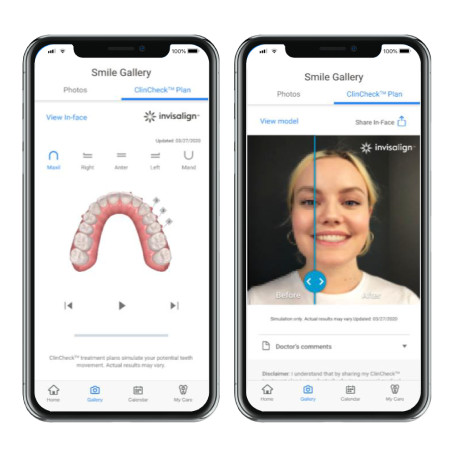 ClinCheck treatment plan on My Invisalign app mobile view