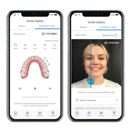 ClinCheck treatment plan on My Invisalign app mobile view