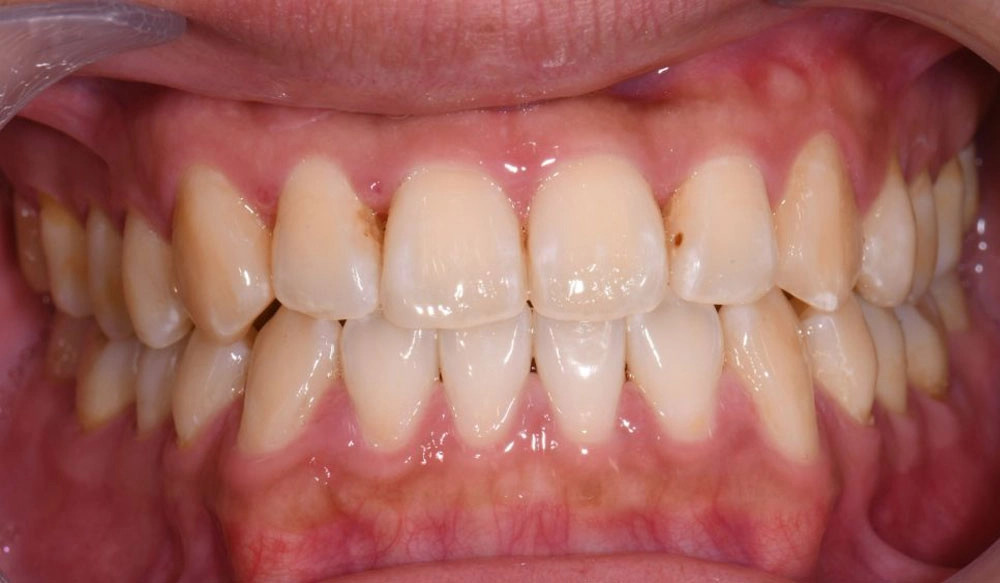 Class III tooth case after Invisalign® treatment