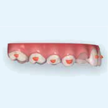 photo-card-invisalign-first-predictable-dental-arch-expansion