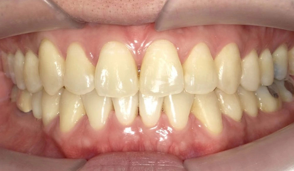 Anterior crossbite tooth case after Invisalign® treatment