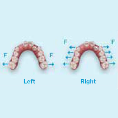 photo-card-invisalign-first-smart-stage-technology