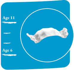 image-card-age-11-palatal-expander