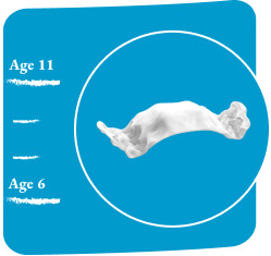 image-card-age-11-palatal-expander