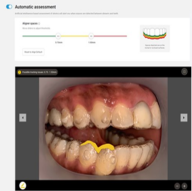 AI guided automatic assessment uses doctor settings to objectively measure aligner spaces.