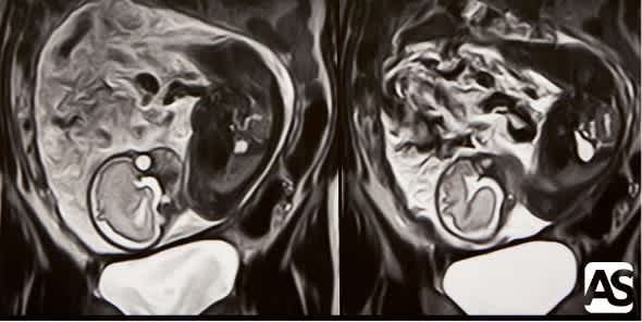 Crecimiento intrauterino retardado: ¿qué es y cuáles son sus causas?