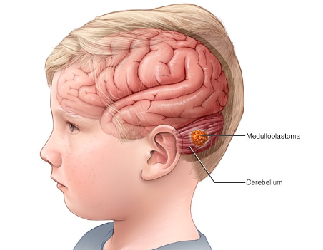¿Qué es un meduloblastoma?