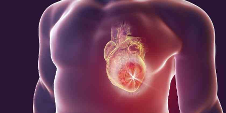 Síntomas de un infarto y qué hacer