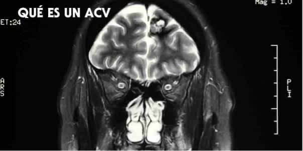 ¿Qué es un Accidente Cerebrovascular o ACV? Síntomas y tratamientos